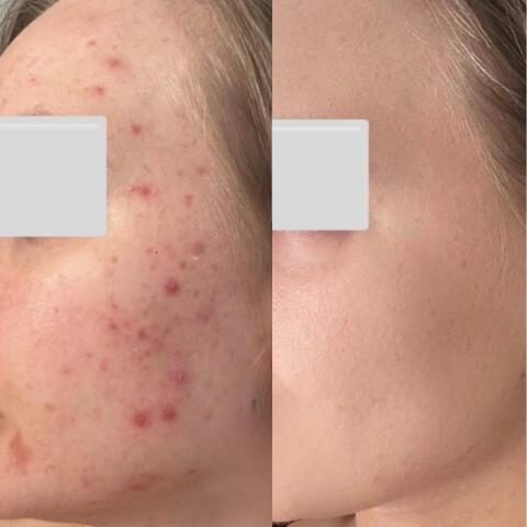 Before and after acne facial at Karina Skin Studio — clear smooth skin after treatment