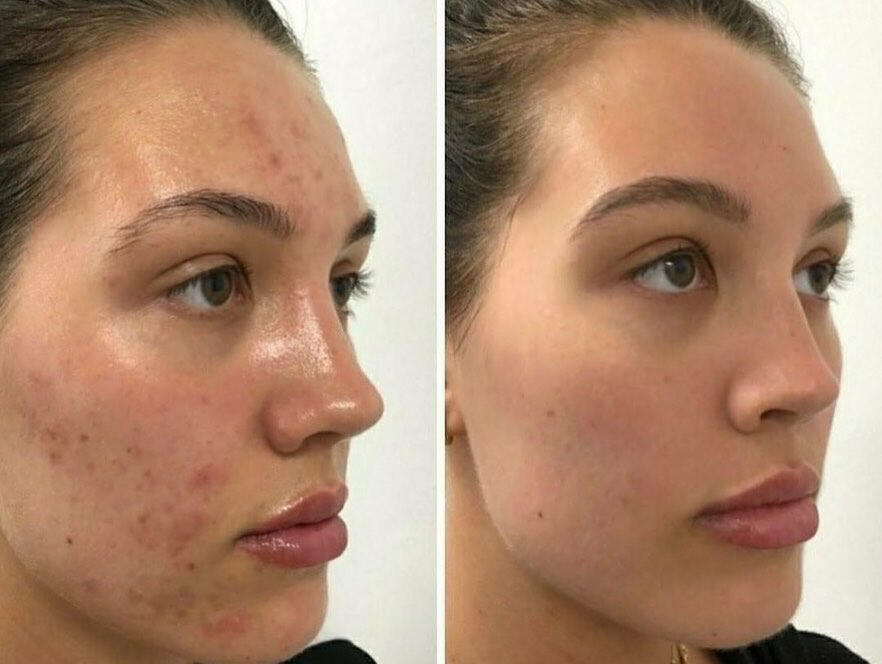 Before and after Brightening treatment results at Karina Skin Studio Downtown LA