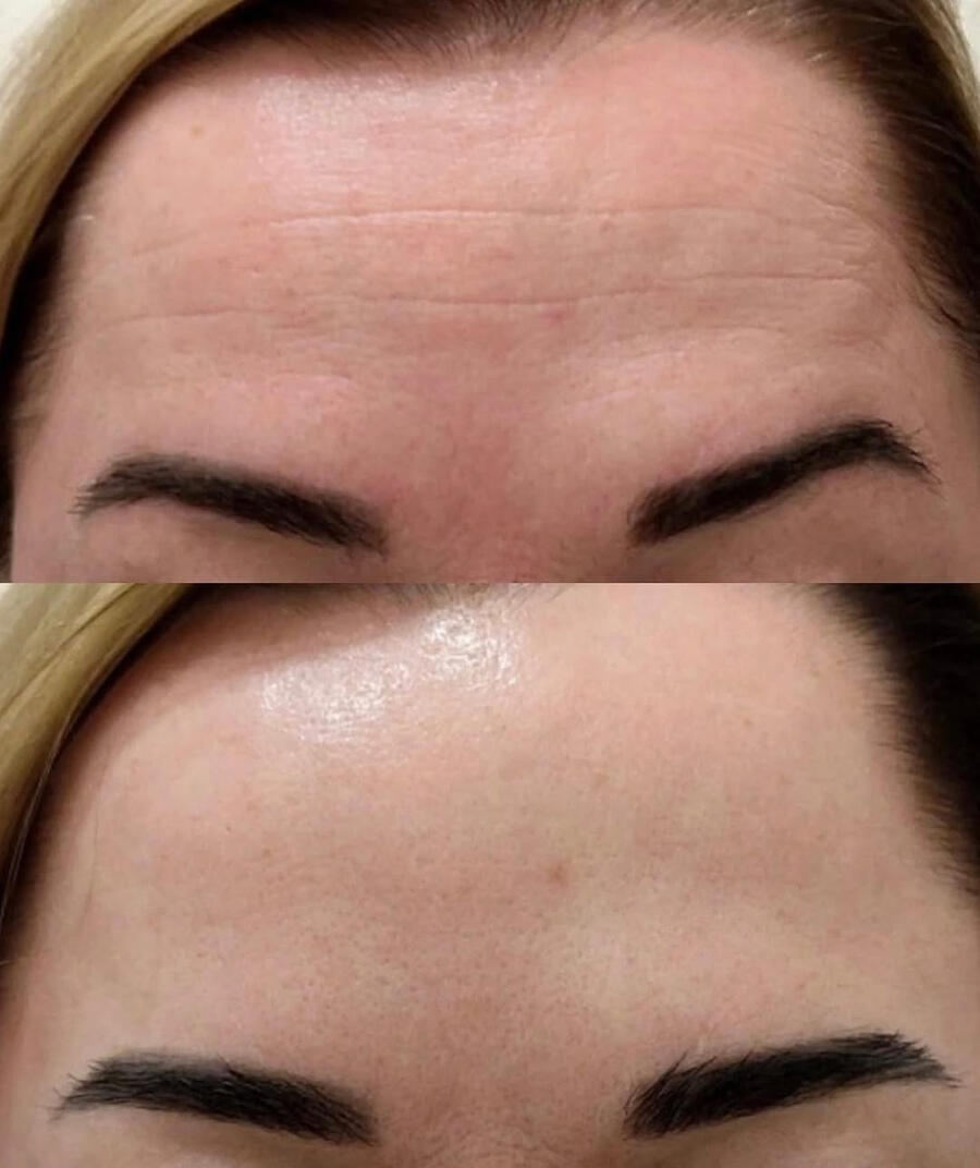 Before and after anti-aging facial at Karina Skin Studio — fine lines softened and skin looks radiant