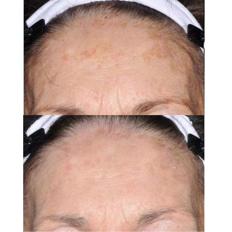 Before and after pigmentation facial at Karina Skin Studio — dark spots faded to even skin tone